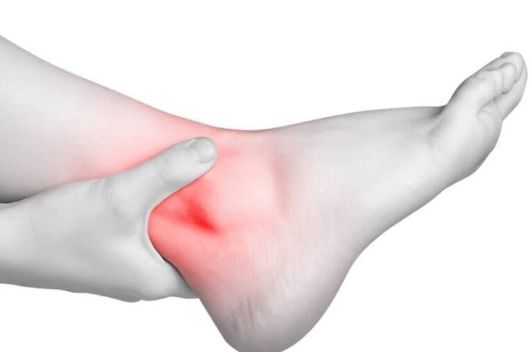 Joint inflammation with gout
